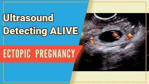 7wks Alive Ectopic Pregnancy - Ultrasound | A Serious Life Threatening Emergency