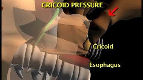 7-44.  Applying Cricoid Pressure