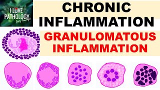 INFLAMMATION Part 9: Chronic Inflammation - GRANULOMATOUS INFLAMMATION