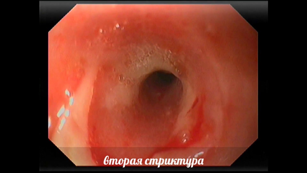 стриктура пищевода, баллонная дилатация