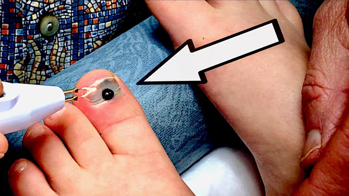 BURNING A HOLE THROUGH A TOENAIL (with blood trapp...