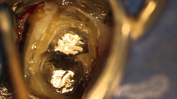 Rootcanals101 - Cast post and core retreatment