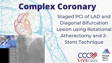 PCI of LAD & Diagonal Bifurcation Lesion using Rotational Atherectomy & 2-Stent Technique Feb 2016