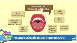 “รอยโรคก่อนเป็นมะเร็งช่องปาก” จะสังเกตได้อย่างไร? : Rama Square ช่วง ปากสวย - โสตใส 5 เม.ย.60 (3/4)