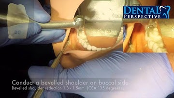 Crown Prep  PFM HD - Dental Perspective