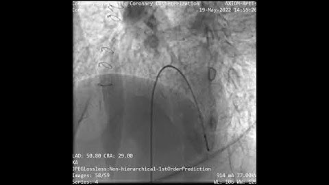 TGA, VSD, ASD ,PS , well functioning ,Aneurysmal Glenn anastomosis