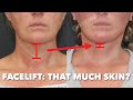 Her skin moved how much with a facelift