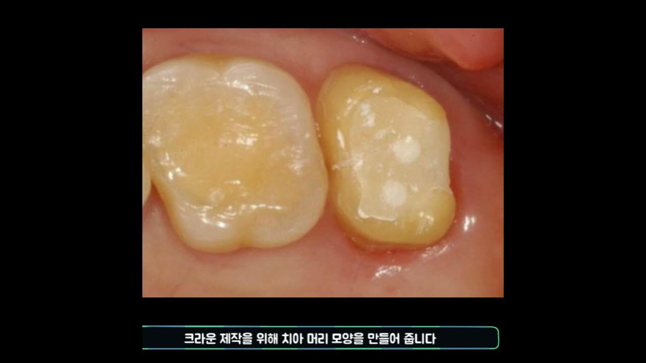 잇몸 부었을 때 잇몸 고름주머니 치료 - Youtube