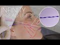 Infinity thread lift with chin and jawline filler combination therapies by dr kian karimi