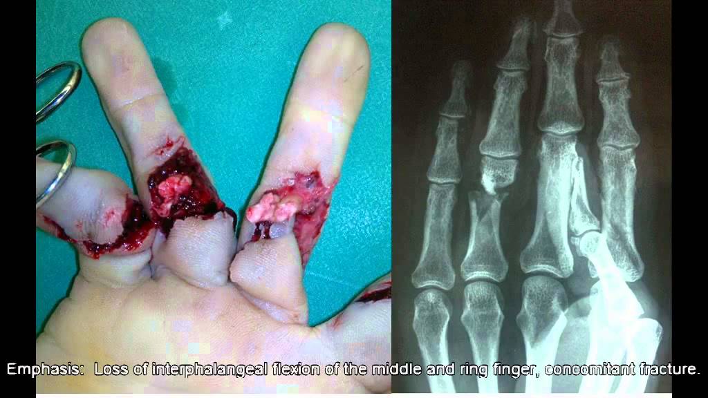 Finger Flexor Tendon Repair and Rehabilitation: Bone Fracture and