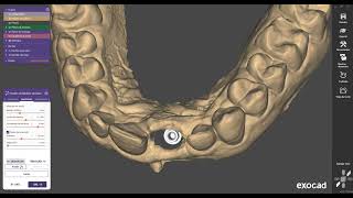 Model Creator Exocad IMPLANTES