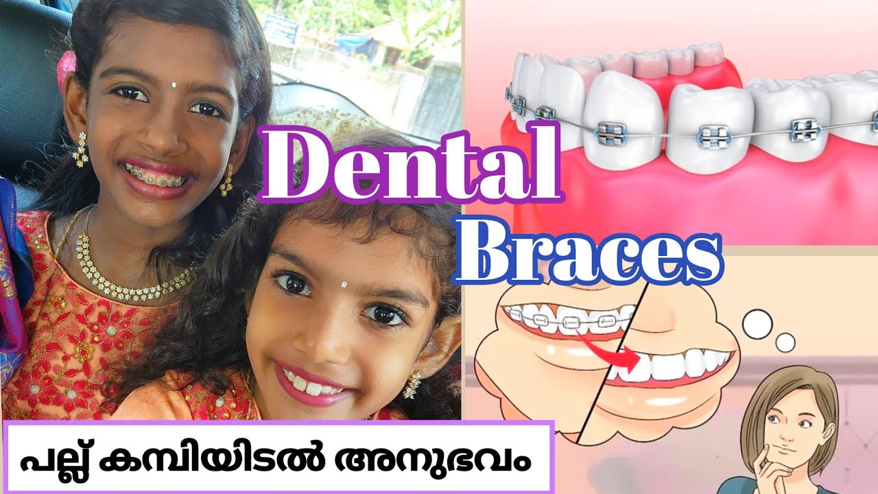 പല്ലിൽ കമ്പിയിടുമ്പോൾ Dental braces experience teeth braces
