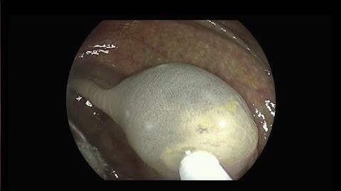 Endoscopic Polypectomy with Eleview™ at Biopsy Site
