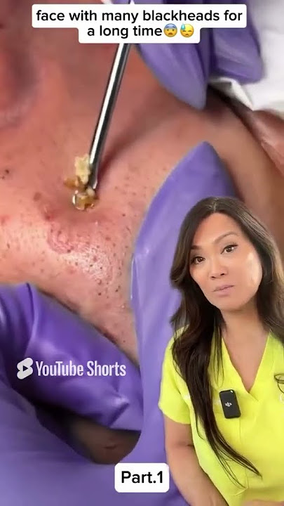 Can Retinol Stop Blackheads Like This?