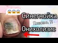 Под покрытием плесень ? Педикюр / онихолизис / отслоение ногтя / синегнойка на ногте /что мы сделали