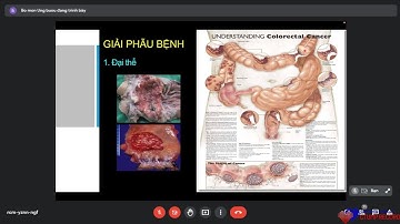 LS UTĐC - Ung thư đại trực tràng