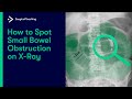 How to Spot Small Bowel Obstruction on X-Ray