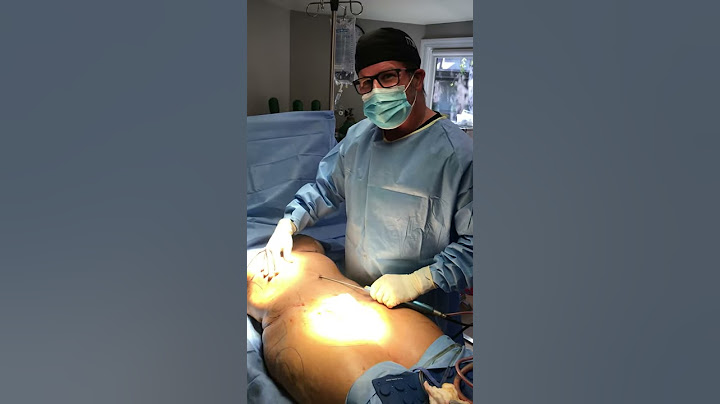 Mommy Makeover with Liposuction and Brazilian Butt Lift
