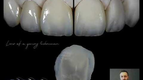 The Staining technique in imitating natural teeth, the IPS Ivocolor system explained