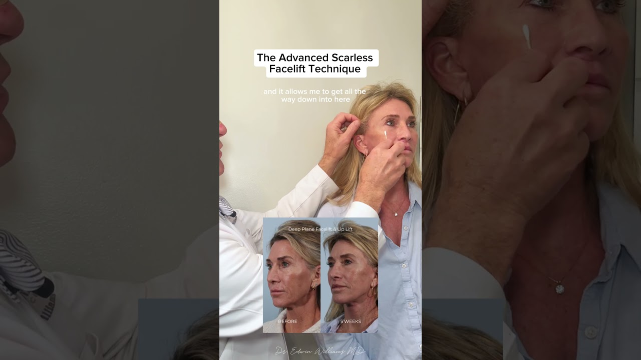 Scarless Facelift Incision Technique Explained 