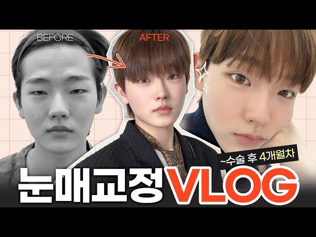 [EN/CN] 이마로 눈뜨는 남자 손🙋‍♂️ 남자비절개눈매교정 4개월 후기 VLOG