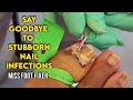 Removal of a 2 Fungal Nail :  Say Goodbye to Stubborn Nail Infections