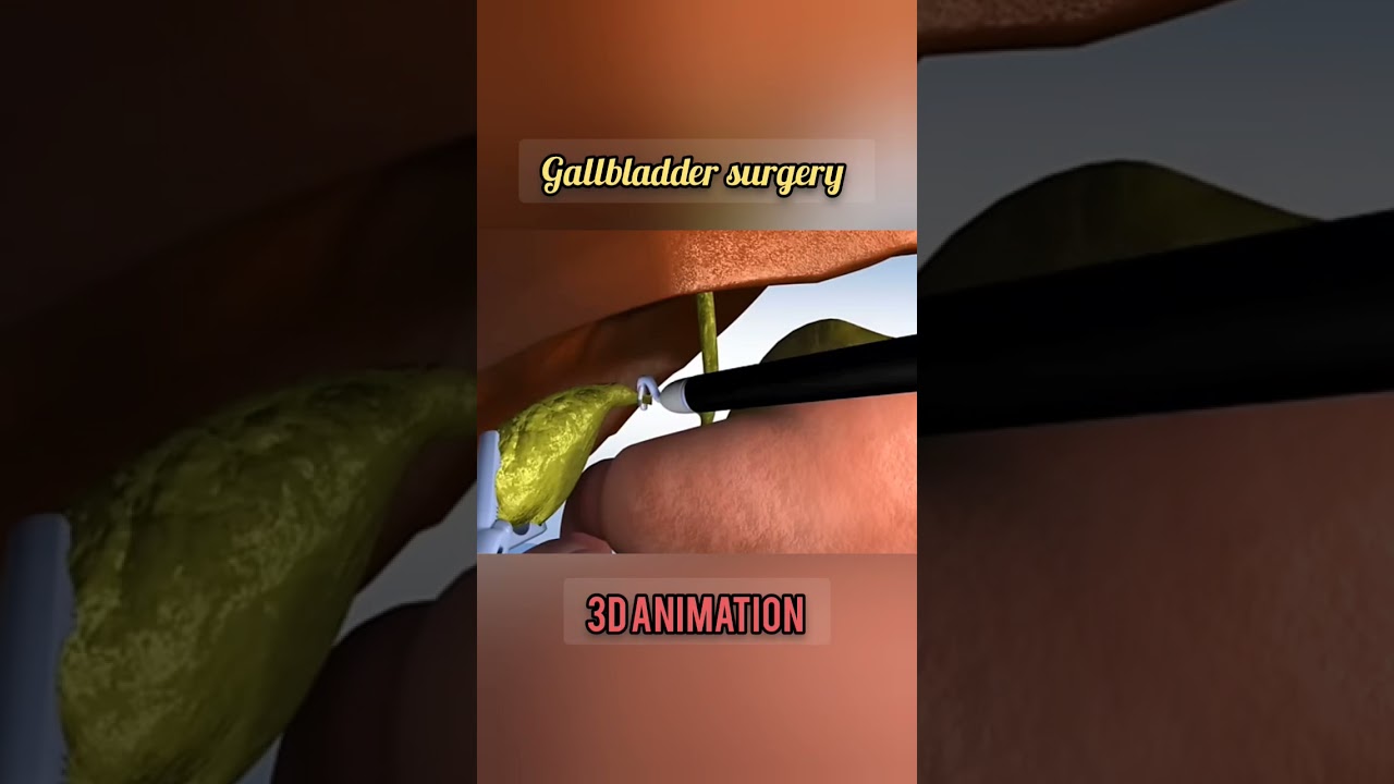 Gallbladder stone surgery | stone surgery | 