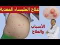 المليساء المعدية العدوى والاعراض والوقاية وطرق العلاج