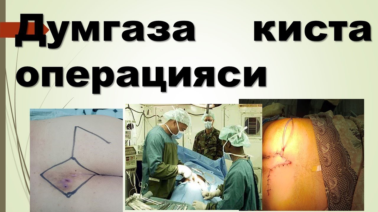 думгаза кистасини  операция килиш