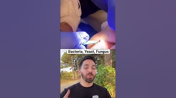Thumbnail of Doctor Reacts to INSANE Splinter | #shorts