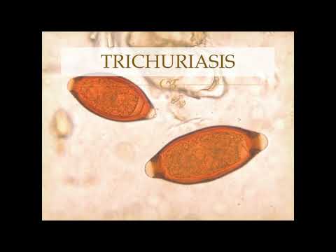 Video: Trichocephalosis - Příznaky, Prevence, Léčba, Diagnostika