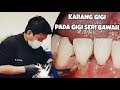 Scaling (Pembersihan karang gigi pada gigi seri bawah)