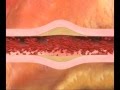Поражение коронарных артерий при синдроме Кавасаки (мульт. пр-во KD Foundation) ©