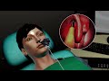 Balloon Sinus Surgery Animation