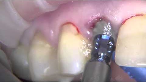 Straumann BLT immediate restoration lateral incisor