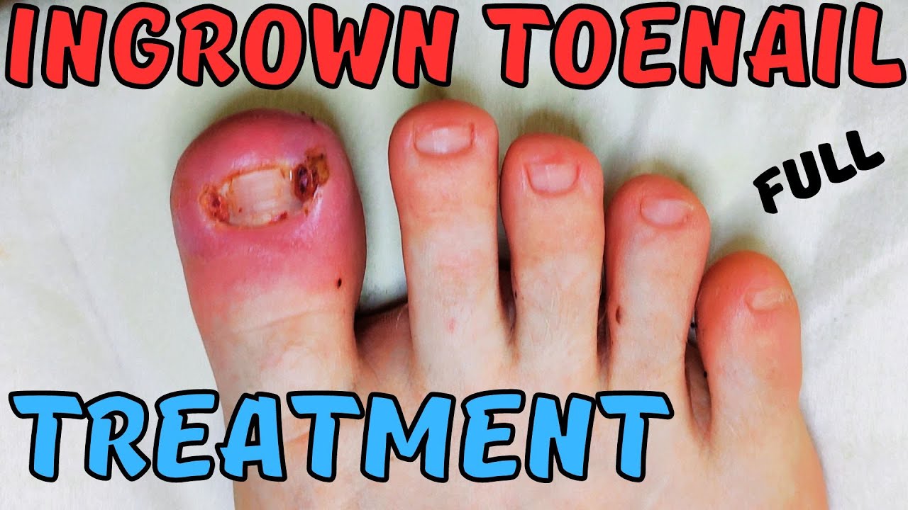 Painful Ingrown Toenail Treatment. YouTube