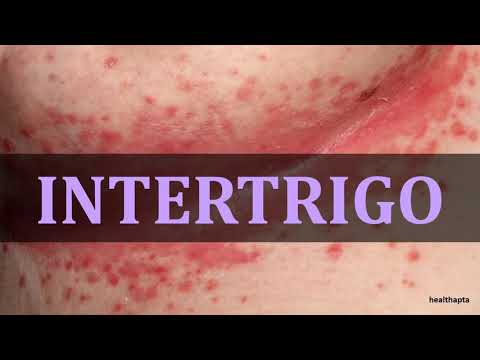 Video: Inverzna Psoriaza Proti Intertrigo: Kakšna Je Razlika?