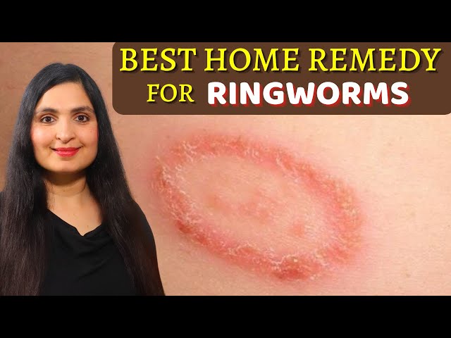 Aude Sapere - FUNGAL SKIN INFECTION/RINGWORM Ringworm is a common fungal  infection, that can cause a red /, silvery ring-like rash on the skin.  Ringworm commonly affects arms and legs but it