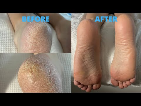 dry skin removal feet｜TikTok Search