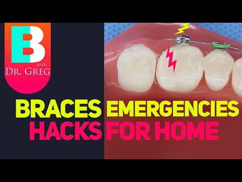 Braces Emergencies Hacks if Orthodontist Closed