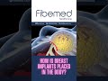 How Is Breast Implant Placed In The Body 