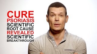 Cure Psoriasis (most common plaque psoriasis), scientific root cause revealed