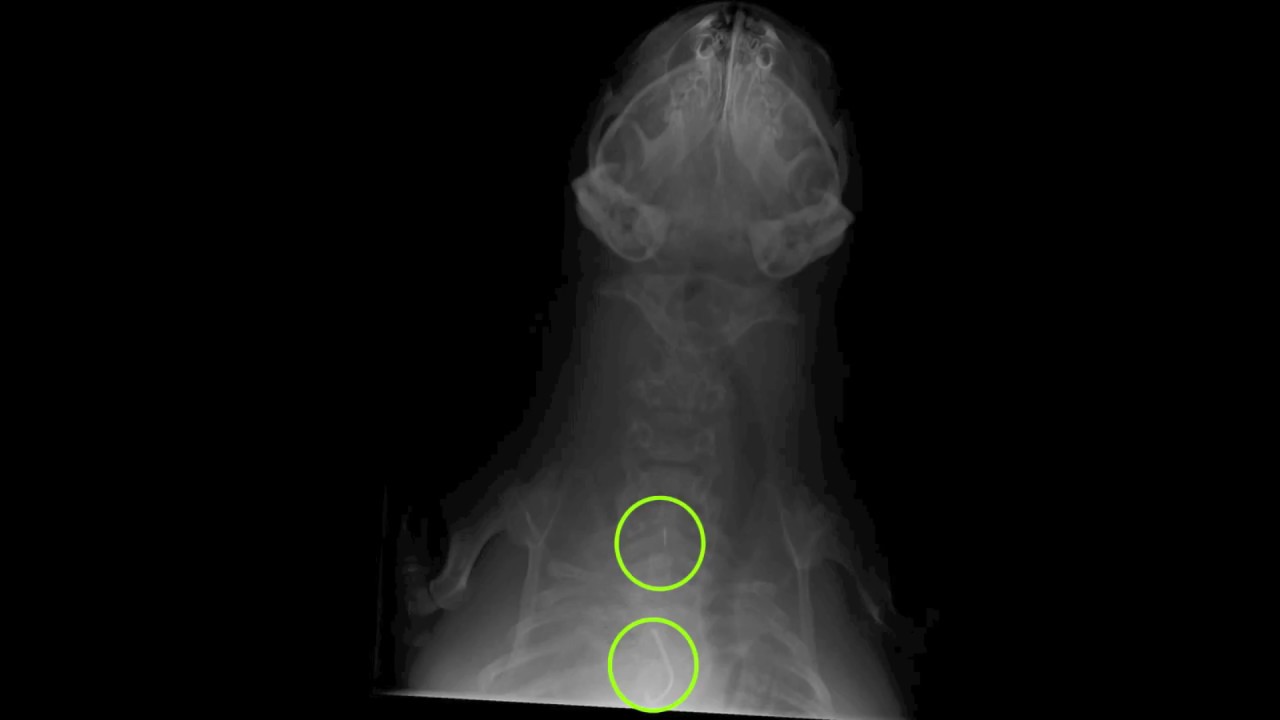 Removal of fish hooks by endoscopy 