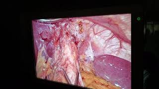 Presented by Jessica L Reynolds, MD at the SS22: All Video All The Time: Foregut Session. March 18, . 