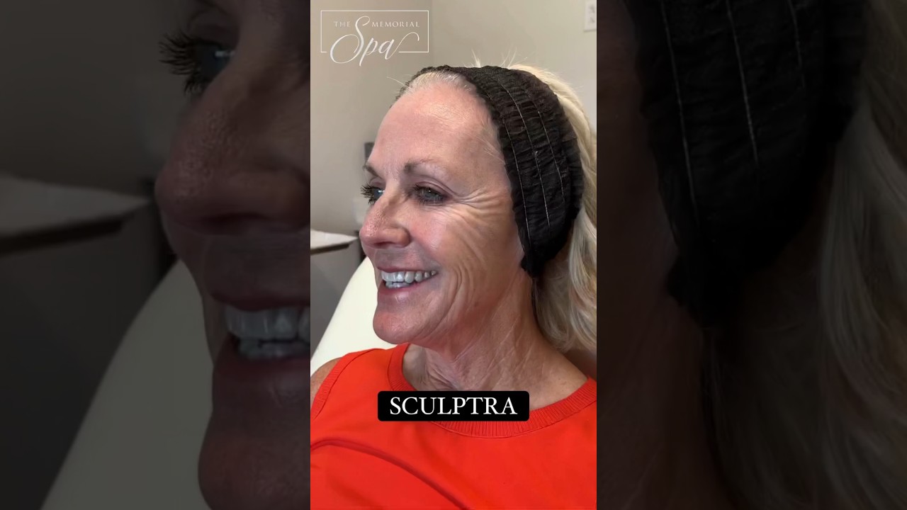 Sculptra: Restore Volume & Youth | Memorial Spa