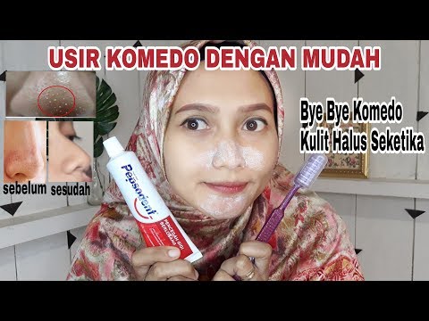 Video: Cara Menghilangkan Komedo Di Dagu Dengan Mudah Di Rumah