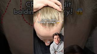 He Saved His Hairline