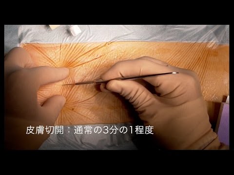 【心臓手術】低侵襲大動脈弁置換術 Minimally Invasive Aortic Valve Replacement