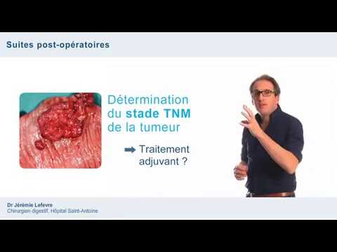 diagnostic du cancer du colon