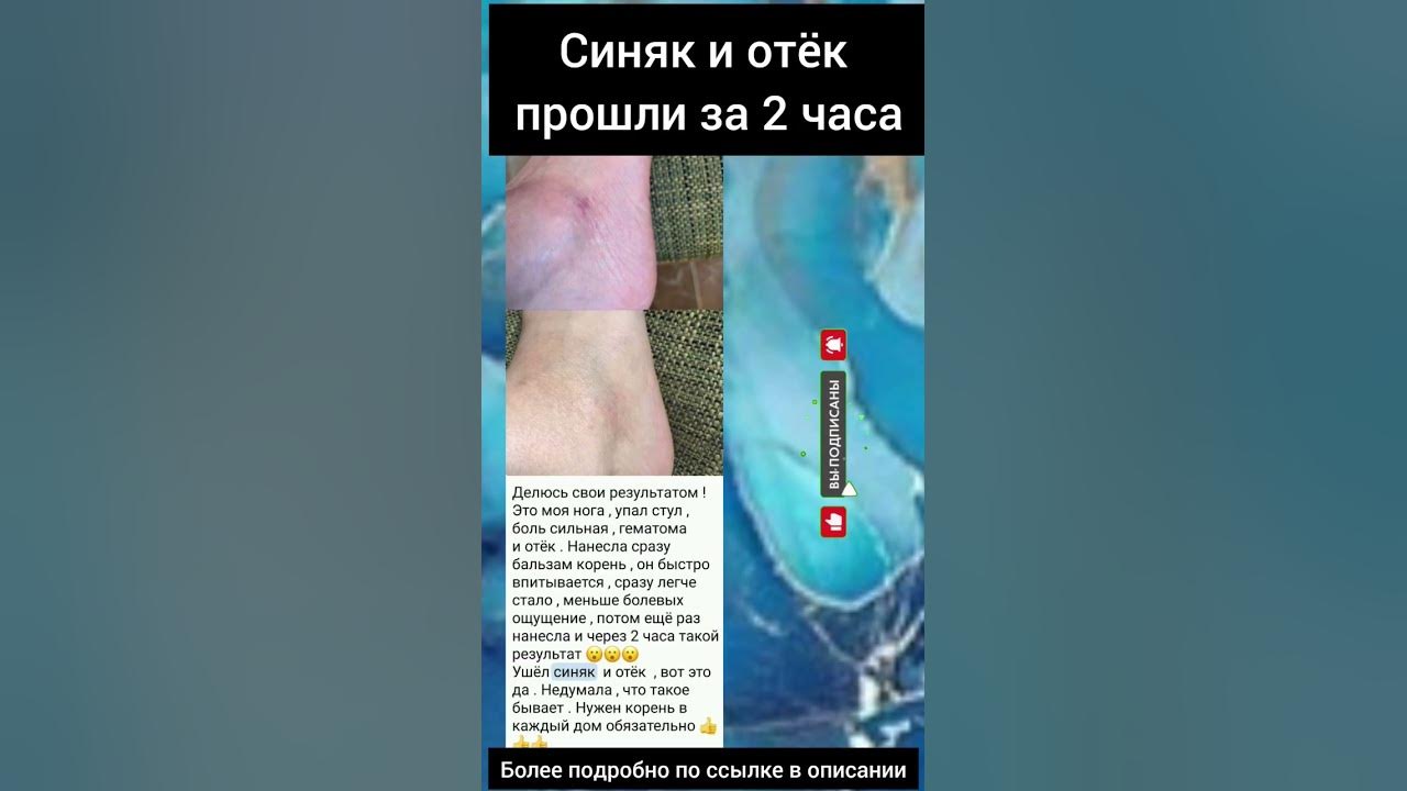Синяк и отёк прошли за 2 часа - YouTube